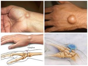 U bao nang hoạt dịch - Hình ảnh minh họa